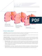 Tuberculose - o Que É, Causas, Sintomas, Tratamento, Tem Cura?