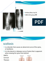 Scoliosis