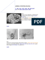 Gambar Avm Intracranial