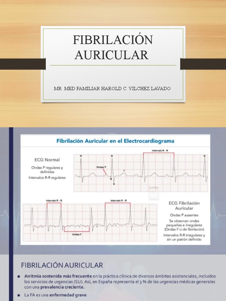 Preguntas Frecuentes De La Fibrilación Auricular – YLEAV