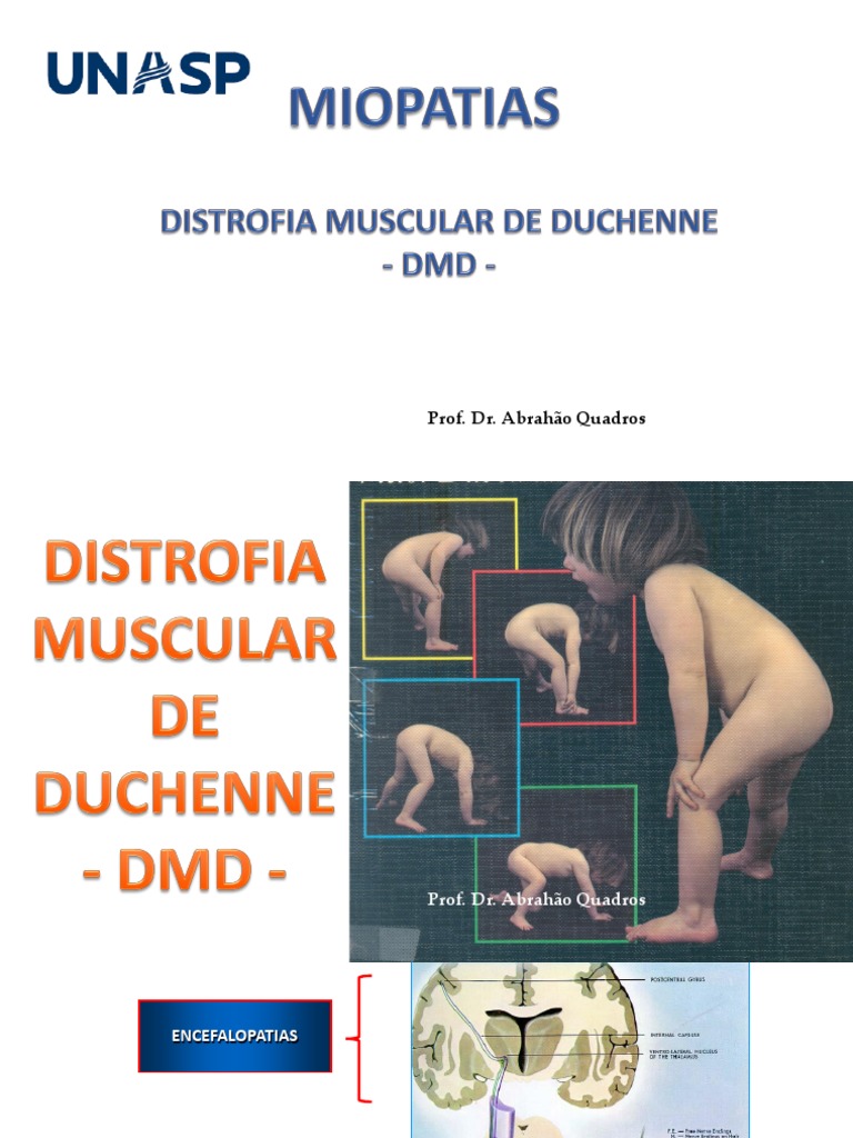 Aula Distrofia Muscular de Duchenne DMD | PDF | Distrofia muscular ...