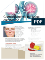 Glomerulonefritis Por Lupus Eritematoso