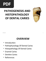Dental Caries Classification Overview | PDF | Tooth Enamel | Tooth