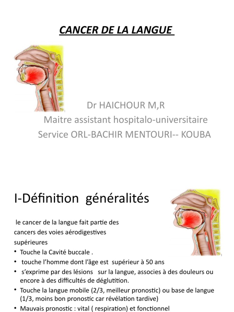 Cancer de La Langue PDF