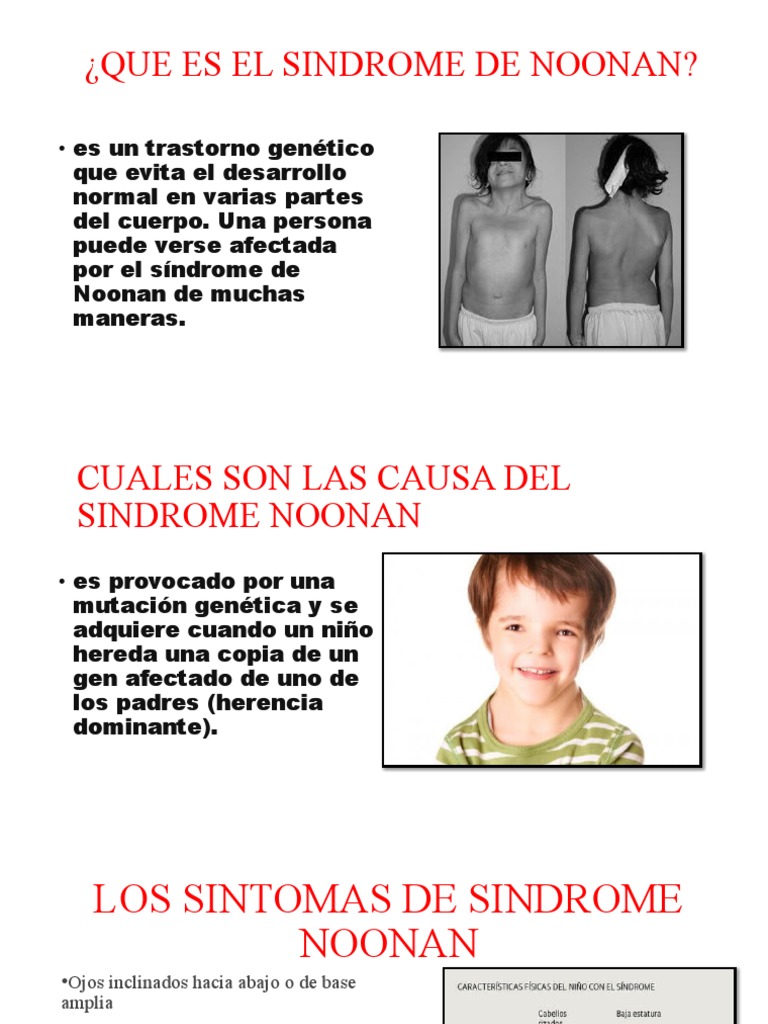 Que Es El Sindrome de Noonan PDF