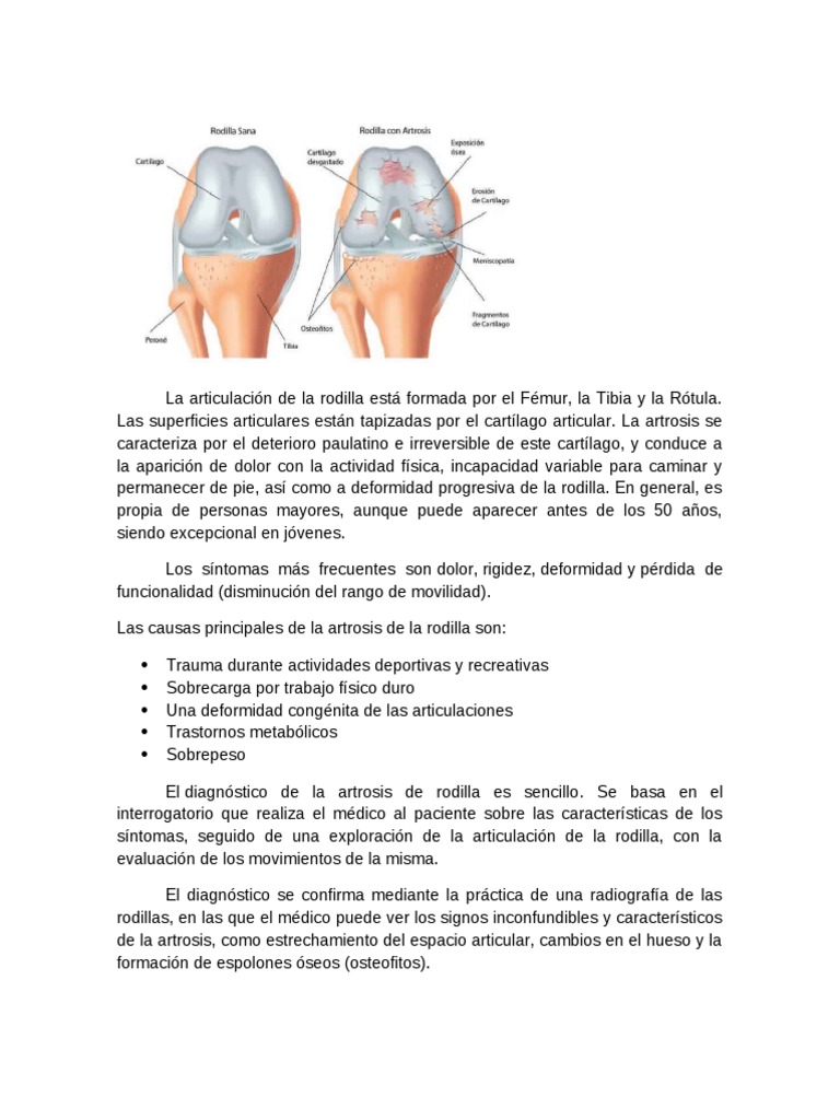 Gonartrosis: Diagnóstico y Tratamiento | PDF | Rodilla | Osteoartritis