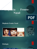 Displacia Fronto Nasal