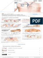 cateter totalmente implantado - Pesquisa Google