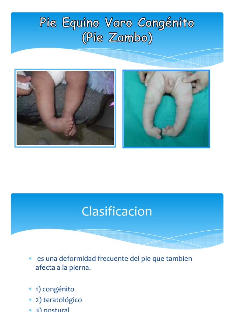Pie Equino Varo Congénito PDF Pie Sistema musculoesquelético