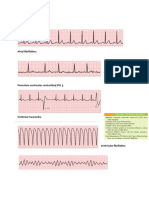 Dysarthymia ECG