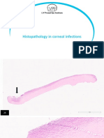 HPE Corneal Infections - Final