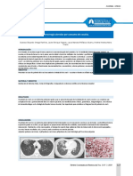 Hemorragia alveolar por consumo de cocaína - Poster XVIII Congreso Colombiano de Neumología