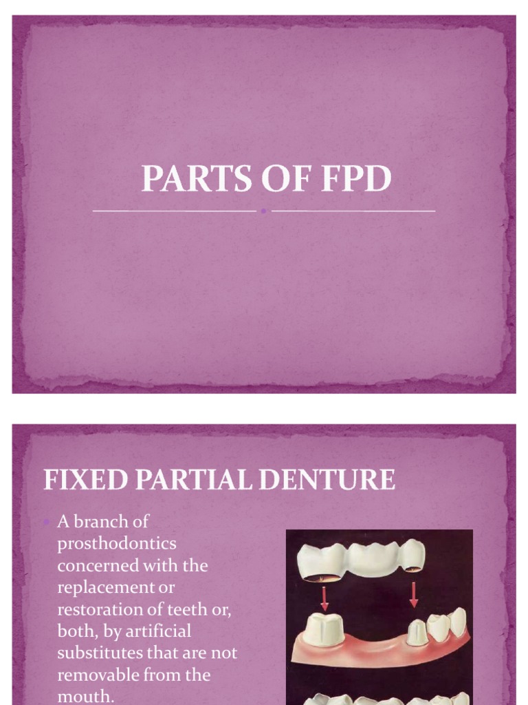 Parts of FPD Dental Implant Dentistry