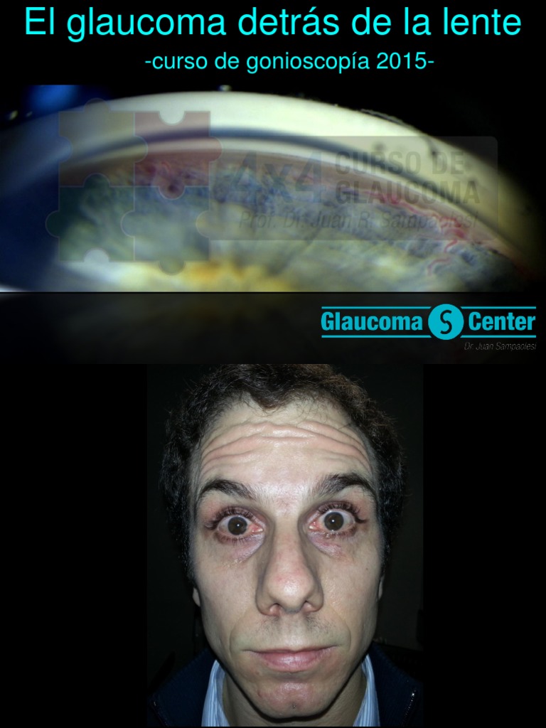 01 Gonioscopia Bases 2015 | PDF | Glaucoma | Ligero, image size:768x1024