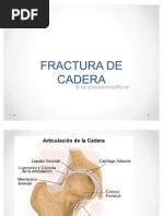 Fractura de Cadera