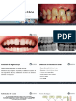 Detección de Las Lesiones de Caries