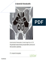 CT of Acute Bacterial Rhinosinusitis