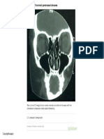 CT Scan of Normal Paranasal Sinuses