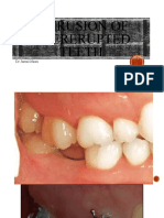 Intrusion of Overerupted Teeth