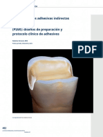 Restauraciones Adhesivas Indirectas (PIAR) : Diseños de Preparación y Protocolo Clínico de Adhesivos