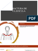 Fractura de Clavicula