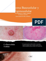 Carcinoma Basocelular y Espinocelular