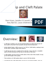 Cleft Lip and Palate Causes and Care