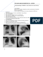 Febre e Infiltrados Pulmonares de Repeticao