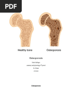 Understanding Osteoporosis: Causes & Treatment | PDF | Osteoporosis | Bone