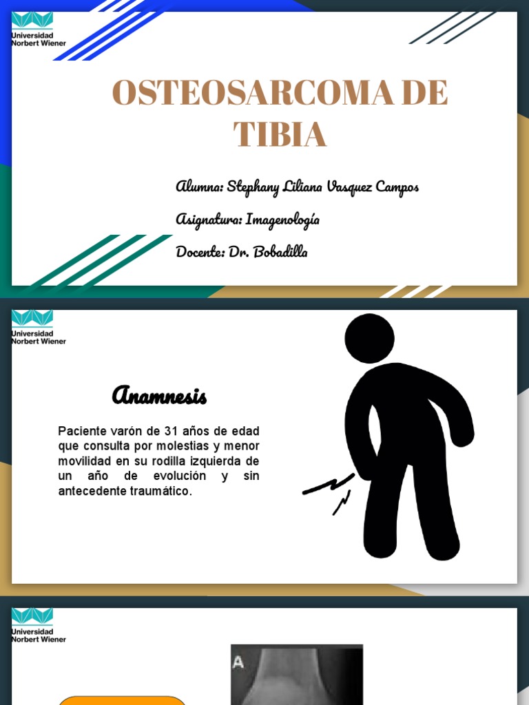 Osteosarcoma de Tibia | PDF
