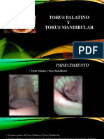 Torus Palatino-Mandibular