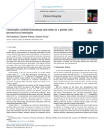 Catastrophic Cerebral Hemorrhage and Edema in A Patient With Pneumococcal Meningitis