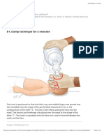 E-C clamp technique neonate - UpToDate