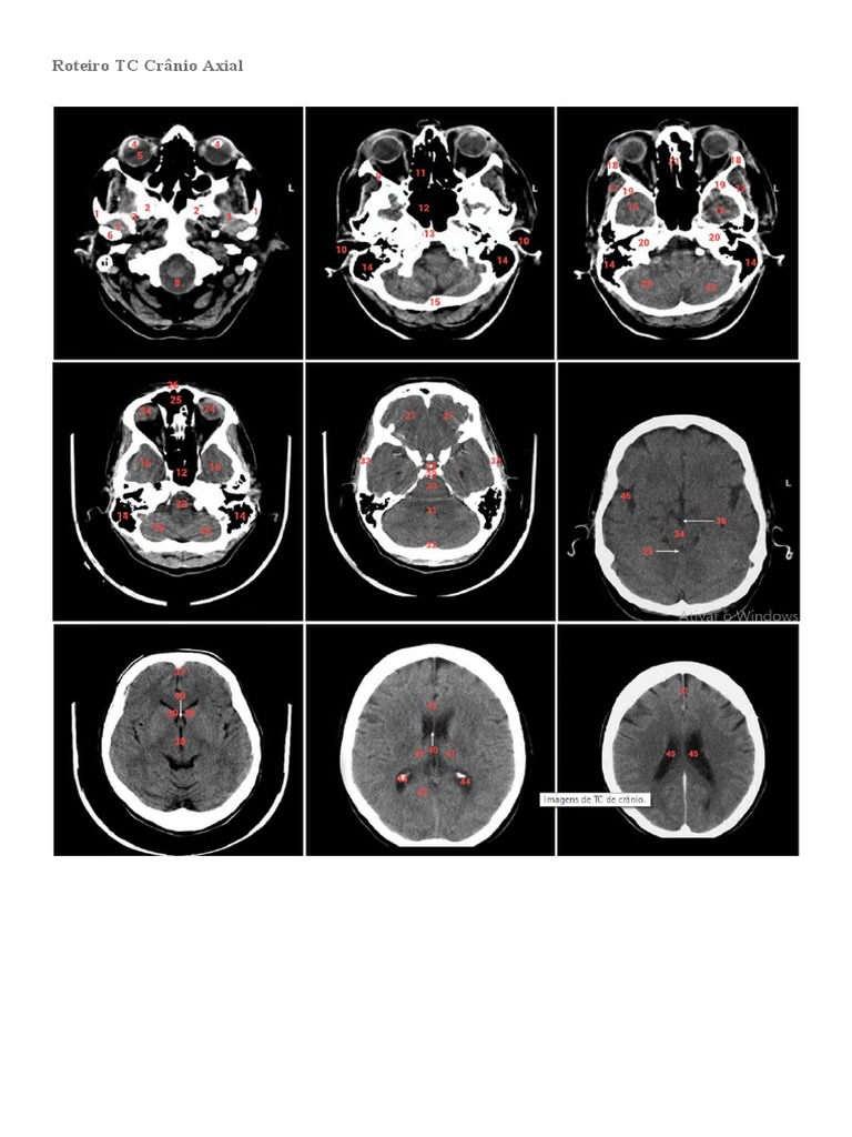 Roteiro Tc Crânio Axial Pdf