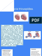 Insuficiencia Tricuspídea.