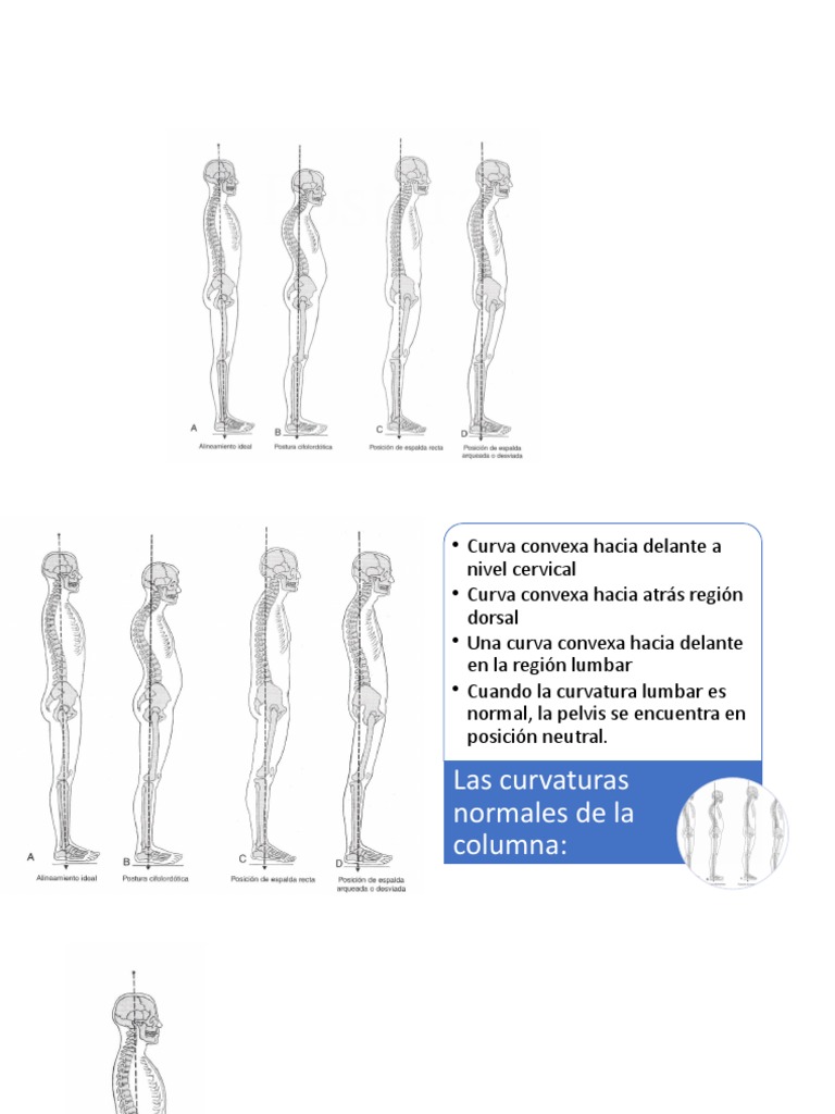 Postura Cifolordótica y Alineación Columna | PDF | La columna vertebral ...