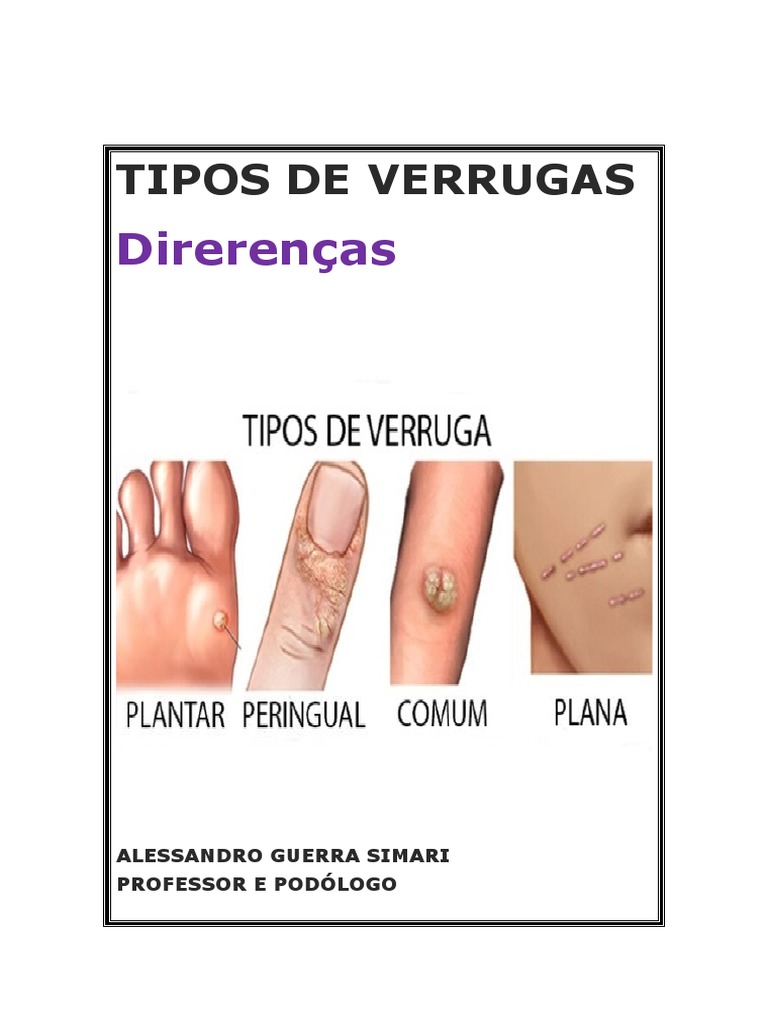 Tipos de Verrugas e HPV | PDF | Vírus | Sistema imunológico
