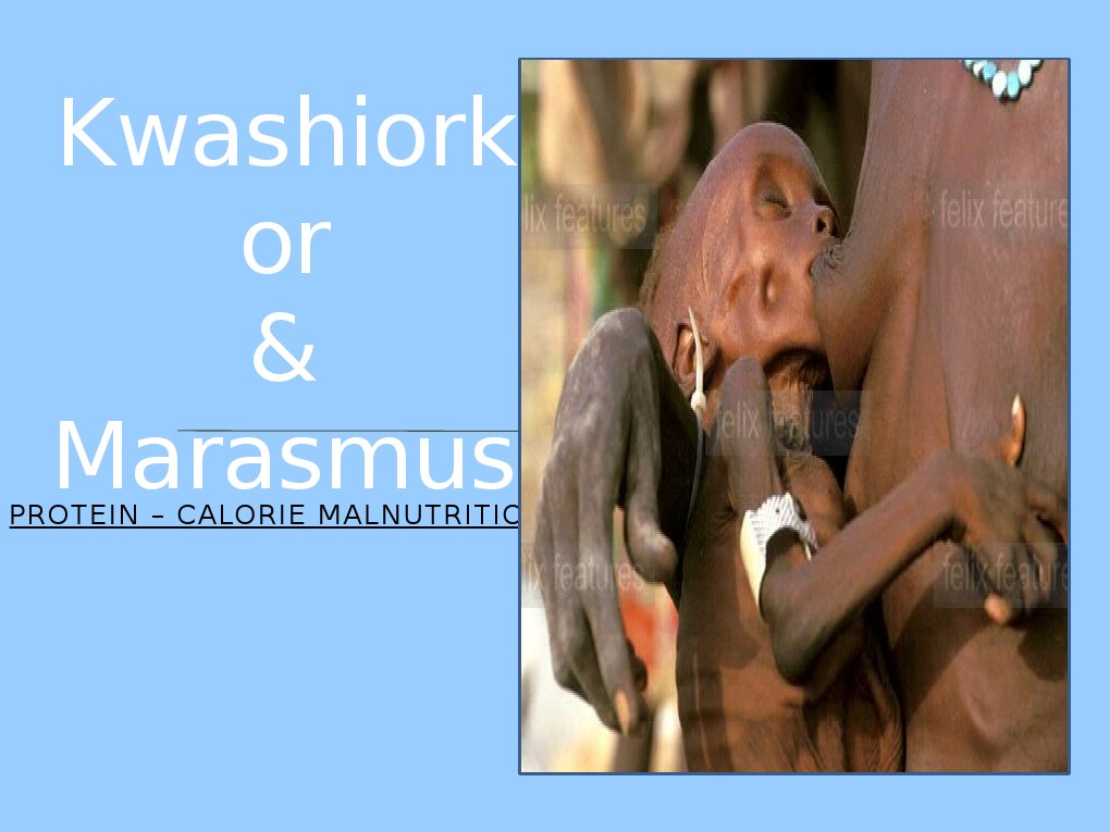 PPP - Kwashiorkor & Marasmus | Malnutrition | Diseases And Disorders