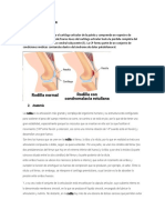 Condromalacia de Rodilla