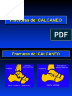 04 - Fracturas Del Calcaneo