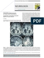 Colpocefalia y Agenesia Parcial Del Cuerpo Calloso