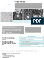 Tumor Cerebral