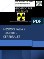 Hidrocefalia y Tumores Cerebrales PDF