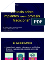 implantes vs tradicional