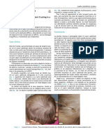 Bebé Con Alopecia Anular y Costras Persistentes: Annular Hair Loss and Persistent Crusting in A Baby
