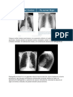 Atelectasia pulmonar lobar derecha