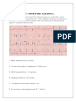 Ekg: Cardiopatia Isquemica.: Nombre: Luis Falcones. Paralelo: C1 Carrera: Medicina