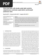 Criss-Cross Heart With Double-Outlet Right Ventricle