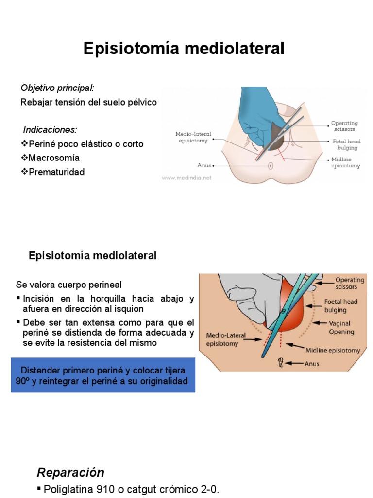 Episiotomía Mediolateral | PDF