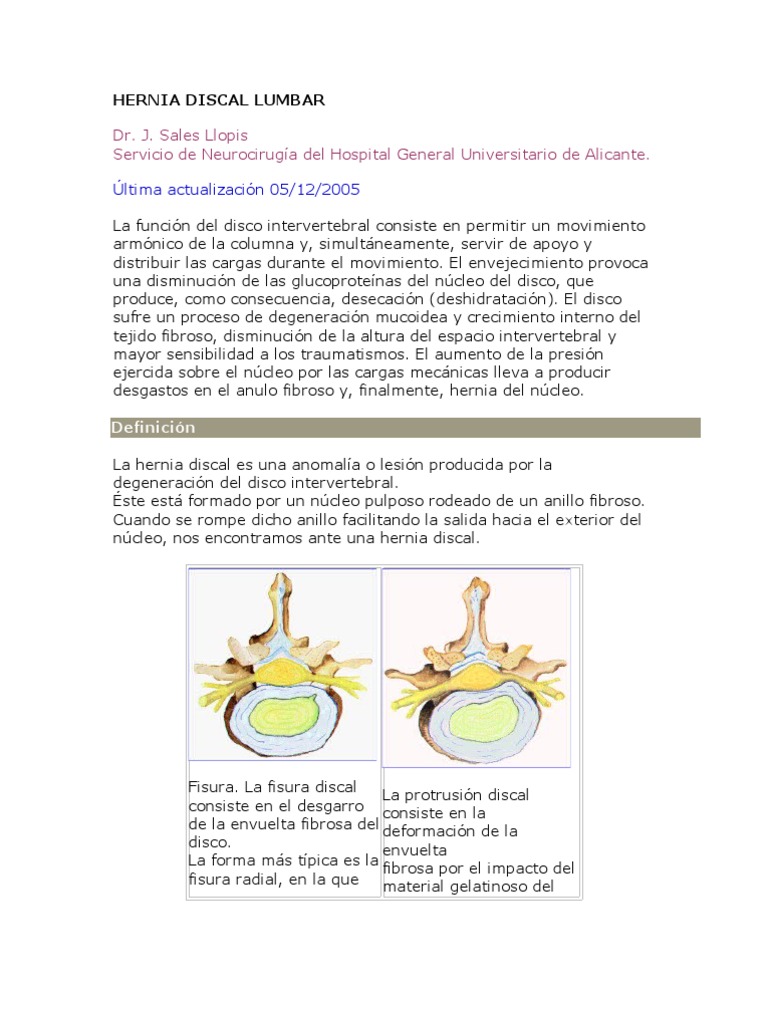 Hernia Discal Lumbar: Causas y Síntomas | PDF | Dolor lumbar | Sistema ...
